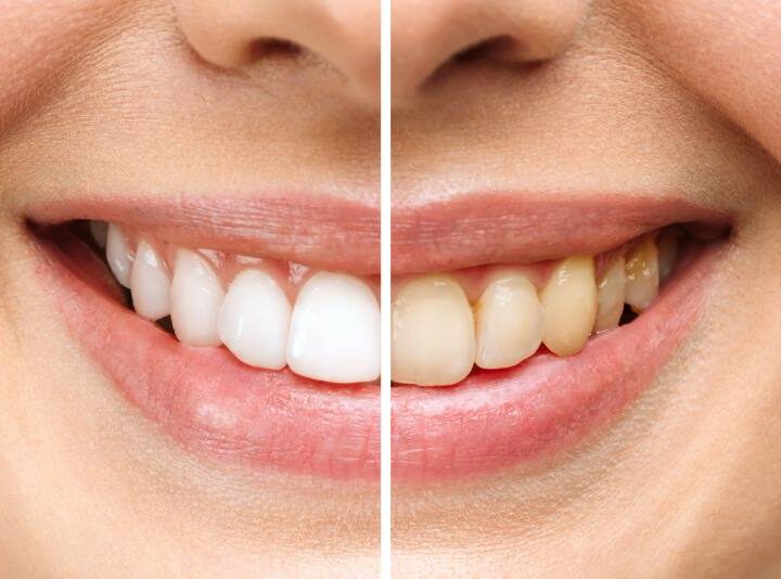 SAVJETI ZA BLISTAV OSMIJEH: Riješite se ovih navika, one najviše štete vašim zubima
