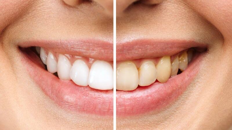 SAVJETI ZA BLISTAV OSMIJEH: Riješite se ovih navika, one najviše štete vašim zubima